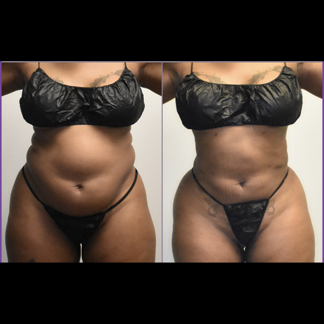 New client special (body sculpting)