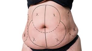 Tummy Tuck